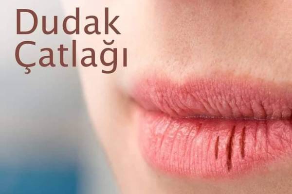 Dudaklar Çatlamasın